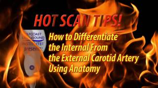 Hot Tip-How to Differentiate the Internal from the  External Carotid Artery