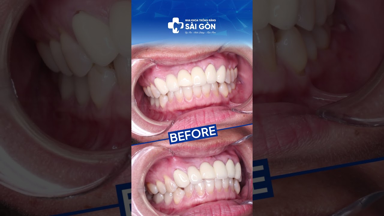 Case Bọc Sứ Toàn Hàm - 24 Răng Toàn Sứ | Nha Khoa Trồng Răng Sài Gòn  #rangsuthammy