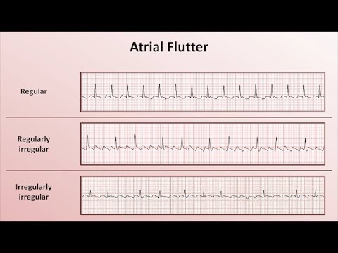 Intro to EKG Interpretation - Overview of Tachyarrhythmias