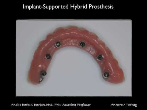 Implant Supported Hybrid Prosthesis