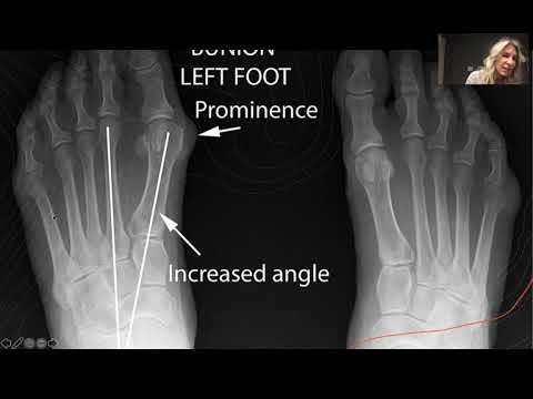 Bunions! Myths, Misconceptions & Movement with Dr Emily Splichal