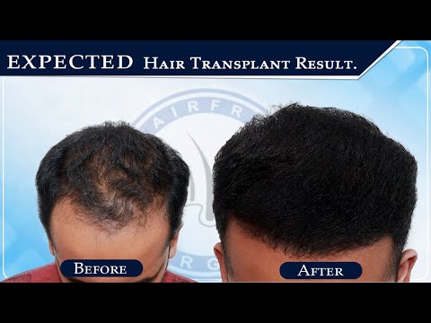 Expected Hair Transplantation Result 👴🏻👨🏻 Hair Transplant Patient Review | HFHG Clinic
