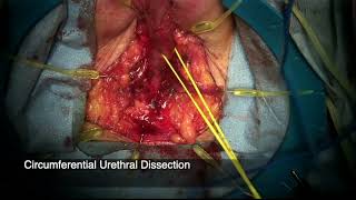 Core Videos (2025): Radical Penectomy with Perineal Urethrostomy