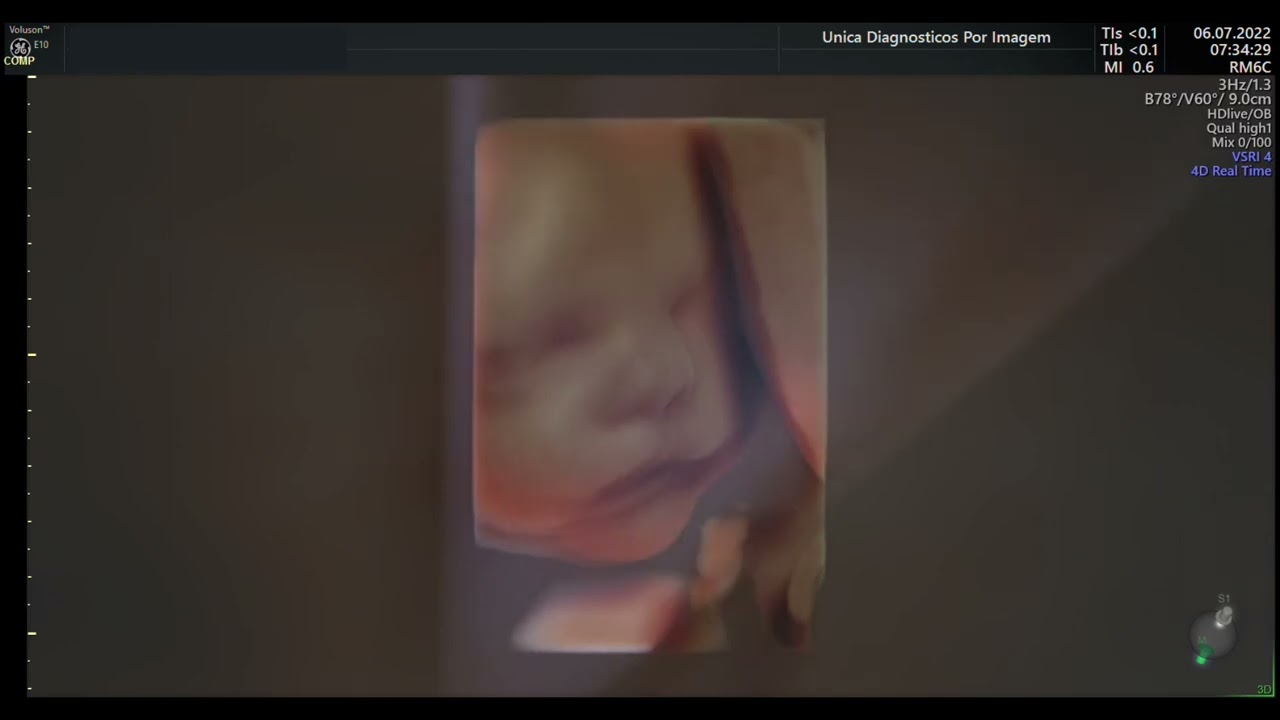 Ultrassom 4D HD Live - 02