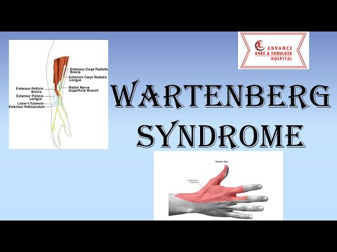 Wartenberg Syndrome : Superficial Radial Nerve Compression Neuropathy
