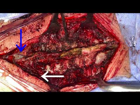 Brachial plexus avulsion neuropathic refractory pain: association of spinal cord stimulation and DREZotomy for complex pain in: Neurosurgical Focus: Video Volume 3 Issue 2 (2020) Journals
