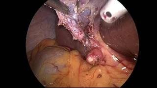 Laparoscopic Cholecystectomy with IOC Laparoscopic Cholecystectomy with IOC