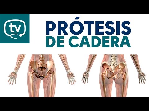 Todo sobre las prótesis de cadera
