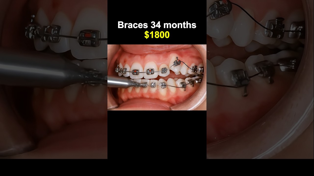 How much for braces? #braces #orthodontist #dentist #teeth