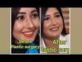 Anchal Sharma plastic surgery | celebrity चटक || Aanchal Sharma