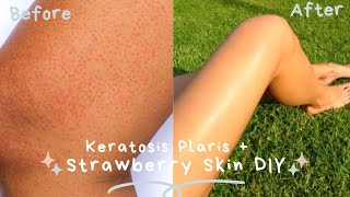 GET RID OF STRAWBERRY LEGS + KERATOSIS PILARIS + DARK SPOT REMOVAL [My At Home Remedy Cure + DIY]