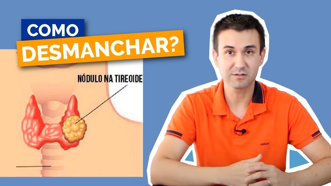 Como desmanchar nódulos de tireoide?