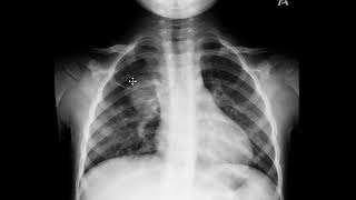 Pneumonias, derrame pleural e atelectasias
