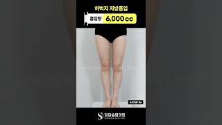 없었던 허벅지틈이 생겼어요