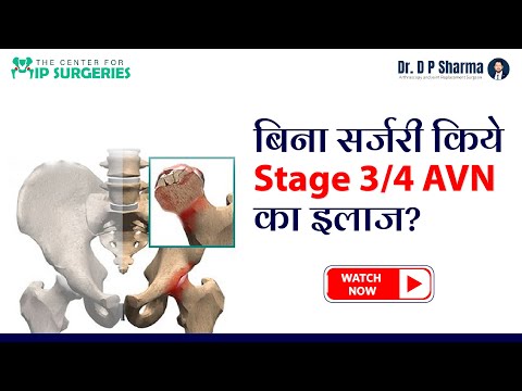 Is It Possible To Treat Stage 3/4 AVN Without Surgery? AVN Treatment In Delhi-NCR  - Dr DP Sharma