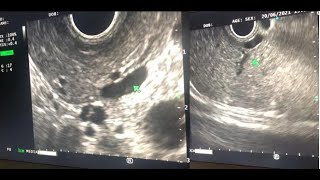 Download Lagu Autoimmune Pancreatitis (AIP2) Presents With Chronic Pain, ... Thumbnail