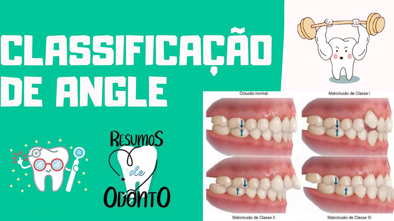Classificação de Angle | Resumos de Odonto
