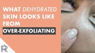 Here Is What Dehydrated Skin Looks Like From Too Much Acid Exfoliation