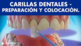 Carillas dentales - Preparación y colocación de carillas ©