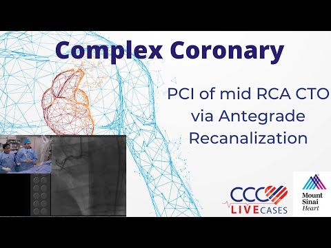 PCI of mid RCA CTO via Antegrade Recanalization – May 15, 2018