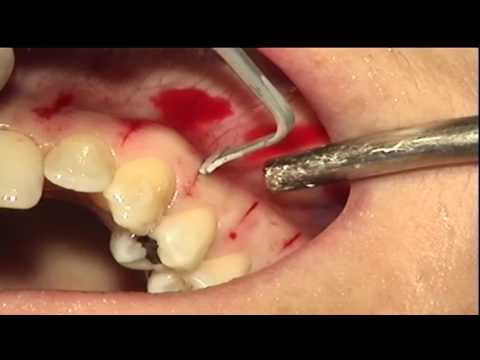 Image for Video Piezocision Clinical Case