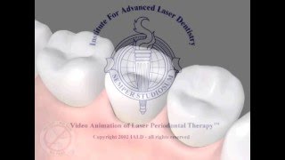 LANAP Dentist Houston Memorial Video Animation
