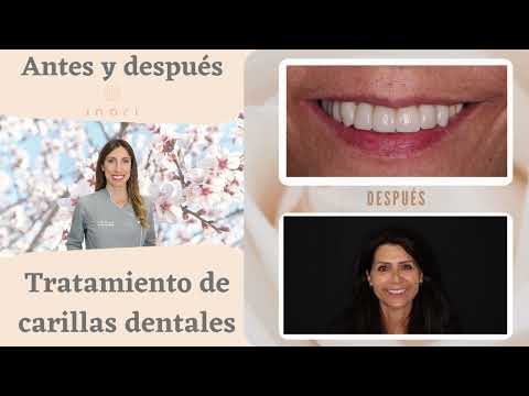 Antes y Después Carillas dentales