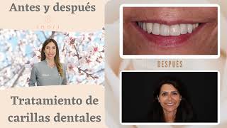 Antes y Después Carillas dentales - Inari Estudio Dental