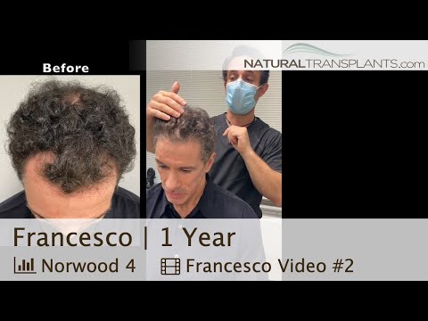 Get the Best Hair Transplant Results at Natural...