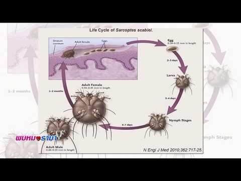 ระคายเคืองสำหรับการรักษา neurodermatitis กะหล่ำปลีในโรคสะเก็ดเงิน
