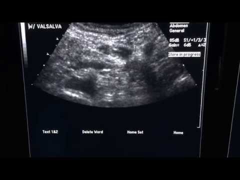 Inguinal Hernia On Ultrasound