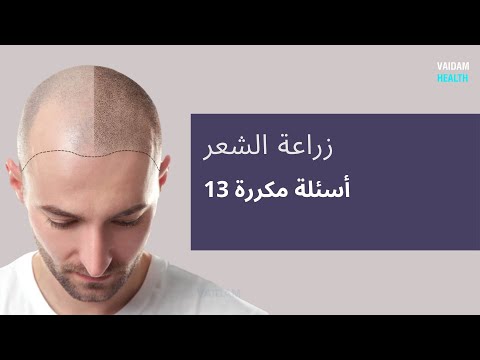 الأسئلة المتداولة حول زراعة الشعر