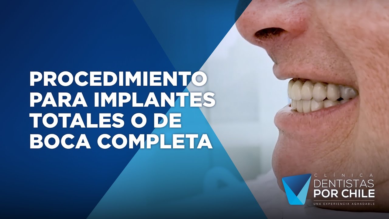 Procedimiento para implantes totales o de boca completa