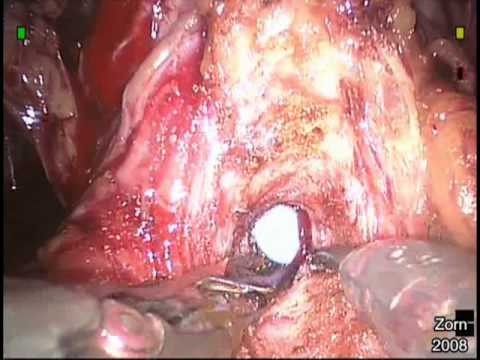 Robotic Radical Prostatectomy - STEP 5-  Bladder Neck Transection