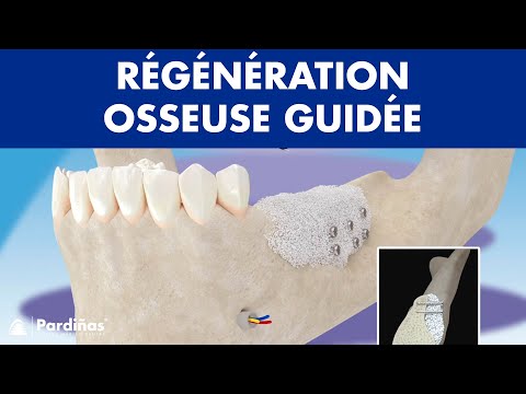 Régénération osseuse guidée ©