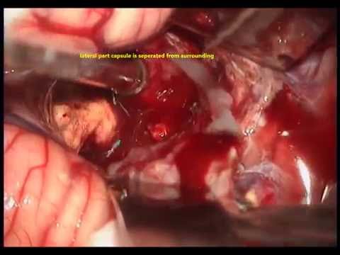 Papillomatosis cervix