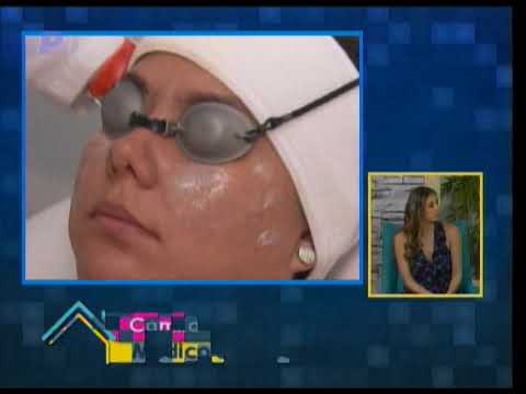 Tratamiento para las secuelas de acné