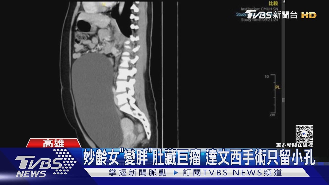 影片/女大生「突然變胖」竟是直徑25公分惡瘤!達文西臂只留小孔