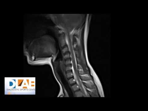 Curare nocche Prenotare complicazioni neurologiche di osteocondrosi e con Nikiforov