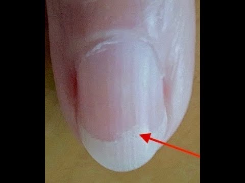 Von welchem Medikament es besser ist, gribok zu behandeln Lozeril 5 ml kostet wieviel