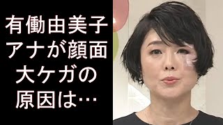 有働由美子アナが顔面大ケガの原因は…news zero降板発表後に衝撃姿、飲酒トラブルや殴られた疑惑も。画像あり
