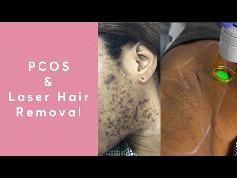 Does Laser Hair Removal Work For PCOS?