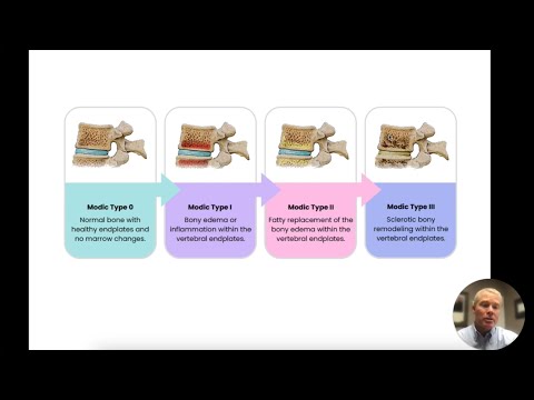 Demystifying Modic Changes | ChiroUp