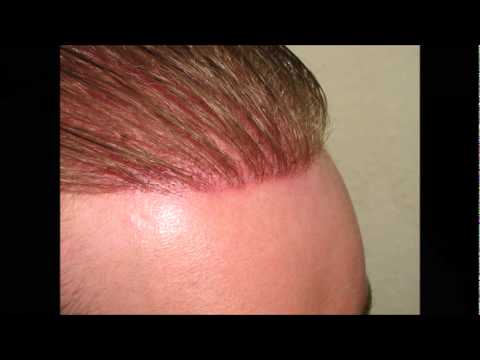 Biofibre Synthetic hair implant the best Clinic Exoderm - Besthetics International Medical Centers