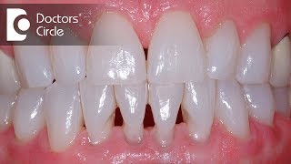 What causes noticable gap left between teeth after cleaning?-Dr. Sowmya Vijapure