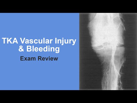 TKA Vascular Injury & Bleeding Exam Review - Thomas Sculco, MD