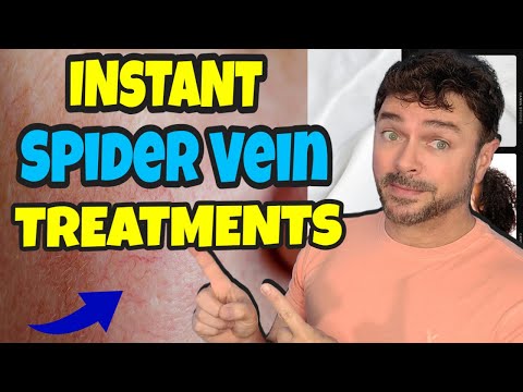 5 Ways To Treat Spider Veins With INSTANT Results! | Chris Gibson