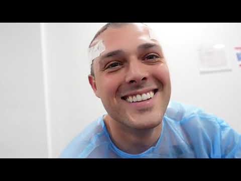 Lewis Ellis FUE Hair Transplant with Surgery Group