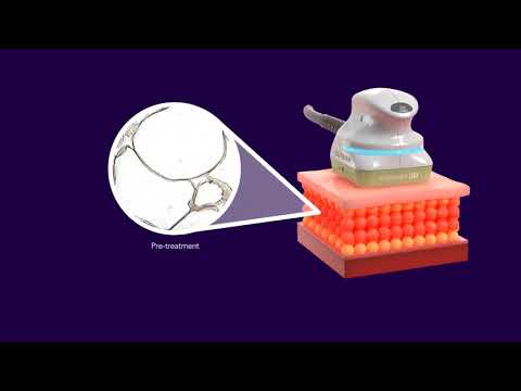 truSculpt 3D now at Lyte Laser Clinic! Adelaide, SA