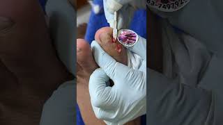 Ep_8155 Foot nail skin removal 👣 This is the source 😄 (clip from Thailand)